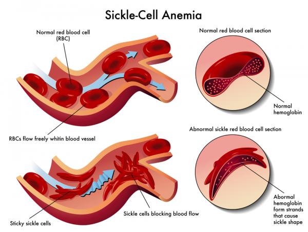 sickle cell 4